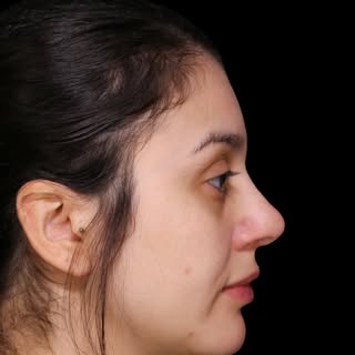 Five months post rhinoplasty for our lovely patient by @drjackkolenda 

[Rhinoplasty] [Toronto Facia