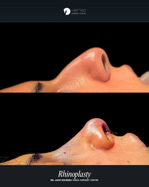 We couldn’t wait to show our patients rhinoplasty results immediately post surgery by @drjackkolenda
