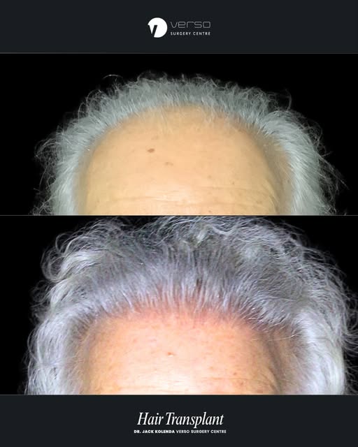 A natural-looking hairline is one of the most important details of a successful hair transplant.

It