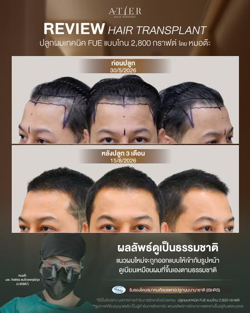🔥 ขมับเว้า ผมร่นเป็นตัว M…อยากเปลี่ยน Hairline ต้องดูเคสนี้!

รีวิวปลูกผม 2,800 กราฟต์ โดยหมอต๊ะ 🤍