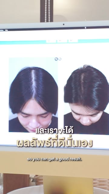 🔥 “เมื่อก่อนผมเว้าเป็นตัว M จนไม่กล้าเซ็ตผม…ตอนนี้ผมเป๊ะทุกงาน!”

กลับมาติดตามผลปลูกผมครบ 4 เดือน ก