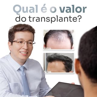 O transplante capilar é muito mais do que um valor monetário. 
É uma arte que exige uma abordagem in