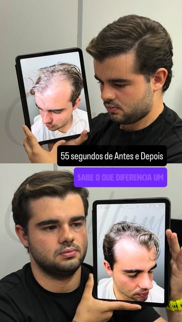 Antes e depois de transplante capilar em detalhes