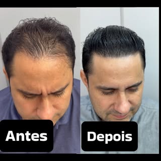 Aqui no perfil, todo paciente que você vê é transplante capilar. 
Transplante capilar de alta qualid
