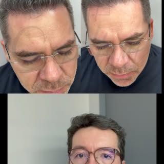 Ser imperceptível é o maior elogio que um transplante capilar pode receber. 

💈Esse resultado é de 
