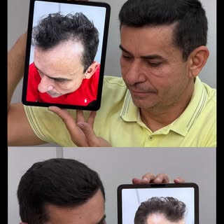 Ninguém acreditou que esse paciente fez o transplante capilar — de tão natural que ficou o resultado