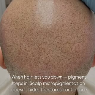 IN PROCESS ….
SMP België #smp#smpmaster#tattooscalp#scalptattoo