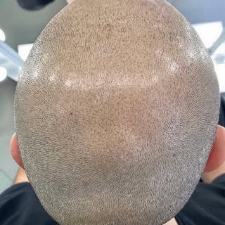 Healed scalp micropigmentation after the first session.#smp#smpbelgium#belgium#haarbelgie