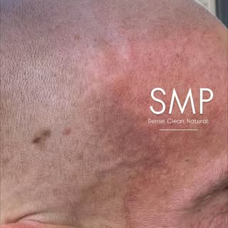 Scalpigmentation in België 🇧🇪