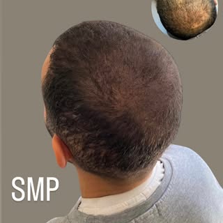 #smp#smpbelgium#scalpmicropigmentation