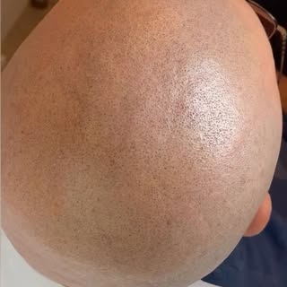 Healed result that’s indistinguishable from real hair. #smp#smpbelgium#scalpigmentation