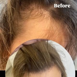 Healed Scalpigmentation #belgium #smp #scalpmicropigmentation #smpbelgium