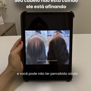 Nem toda perda de cabelo começa com queda intensa
Muitas vezes, ela começa de forma silenciosa afina