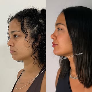 Perfiloplastia

O melhor resultado não é aquele que revela um procedimento.

É aquele que revela uma