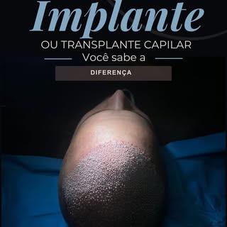Implante ou Transplante Capilar: Desmistificando os Termos! 🤔✨

Você sabe qual é a real diferença e