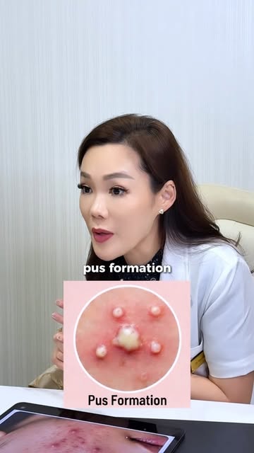 I’ve been telling the acne story for many years, and I’m still just as passionate about helping peop