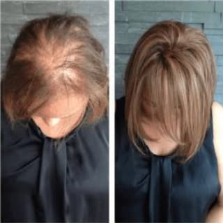 Prótesis oncológicas sensitivas ACTIPEL. Lláma para una consulta totalmente gratuita 3319863324