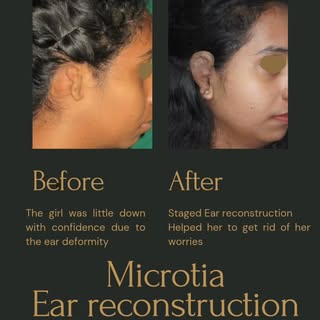 Children born without ear is known as anotia and born with partial ear is known as microtia. 
This y