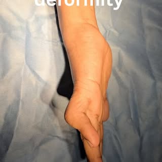 Boutonniere deformity of finger is a real challenge  to correct. 
Here we want to show a previously 