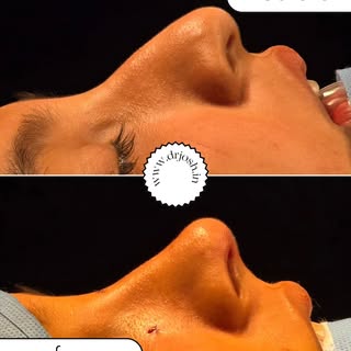 Preservation Rhinoplasty 😍
Rhinoplasty results. ..
Closed rhinoplasty reduces the scar also..😍
Fin