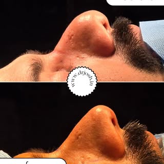 Preservation Rhinoplasty 😍
Rhinoplasty results. ..
Closed rhinoplasty reduces the scar also..😍
Fin