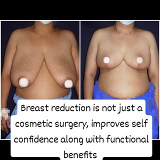 This 60 plus young lady had difficulty in doing day today chores due to the big size breast. It was 