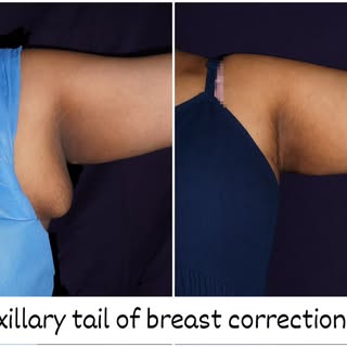 Axillary tail of the breast is really a confidence killer. It prevent the affected individuals from 