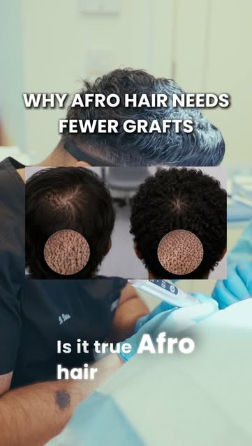 Can Afro-textured hair achieve more coverage with fewer grafts?

Dr Ditta explains why the naturally