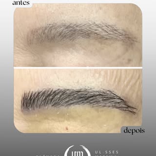Olhar mais marcante e harmonia no rosto? Nós temos a solução!

Com o transplante de sobrancelha, voc