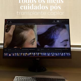 ✨Meus cuidados pós transplante capilar ✨