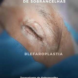 O olhar é um conjunto. ✨

Em alguns pacientes, o envelhecimento não está apenas nas pálpebras. Com o