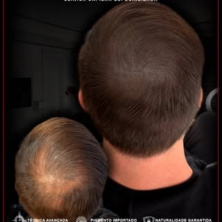 Naturalidade ultra realista criando um efeito natural,
simulando densidade e devolvendo auto estima!