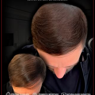 Naturalidade ultra realista criando um efeito natural,
simulando densidade e devolvendo auto estima!