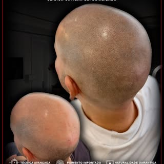 Naturalidade ultra realista criando um efeito natural,
simulando densidade e devolvendo auto estima!