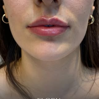 💋 Eloria Medical Aesthetic | Natürliche Schönheit im Fokus ✨
Bei Lippenfüllern ist das wichtigste D