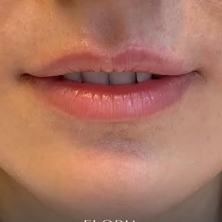 👄 Eloria Medical Aesthetic | Minimaler Eingriff, starke Wirkung
Natürlichkeit bewahren und gleichze