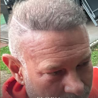 💎 Eloria Medical Aesthetic | Natürliches Aussehen, starke Ergebnisse
Bei einer Haartransplantation 