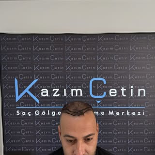 Merkezimizin bugünkü Misafiri Serhat  bey’in daha öncesinde 2 kez saç ekimi yaptırmış olmasına rağme