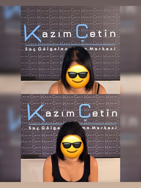 Bugünkü danışanımız  bizleri Fransa’dan ziyaret eden Ayfer  Hanım, yoğun saç dökülmesi şikayeti ile 