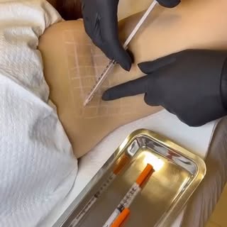 Botox injection for Hyperhidrosis 😀
Botox injections have come to be widely used in managing primar
