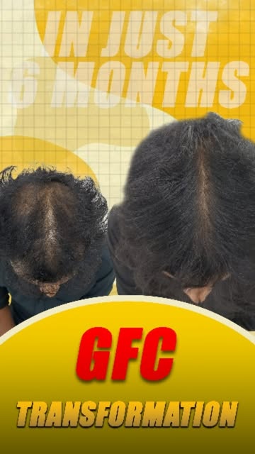 He started losing hair… then this happened. 😱🔥

For appointments call/ whatsapp: +91 98345 12885.
