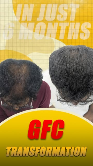 Hair thinning doesn’t happen overnight… but the right treatment plan can make a visible difference. 