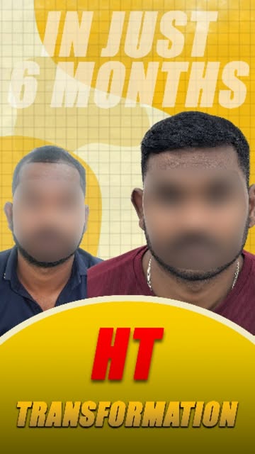 From a receding hairline to a fuller-looking hairline. 😱

For appointments call/ whatsapp: +91 9834