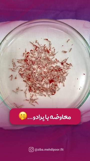 ⁨	⁨	⁨	گرفت ها فقط چند تار مو نیستن🙌🏻

هر گرفت به بافت زندست و نحوه برداشت و کاشتش
مستقیماً روی نتی
