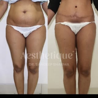 Meet this exceptionally health-conscious 38-year-old lady who was deeply unhappy with her tummy and 