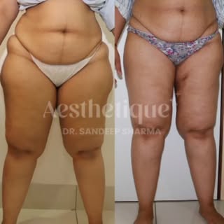 A 35-year-old patient came to us struggling with confidence after her last delivery. She was particu
