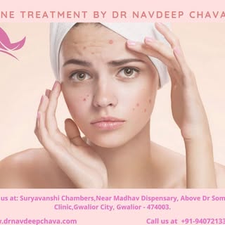 Acne treatment by Dr Navdeep Chavan.
More info visit - www.drnavdeepchavan.com  #AcneProblems #SkinP