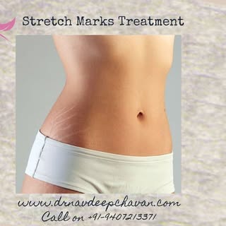 Stretch marks treatment Gwalior 
More info visit our website www.drnavdeepchavan.com