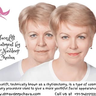 Face lift treatment by Dr Navdeep Chavan Gwalior , India.
More info visit at www.drnavdeepchavan.com