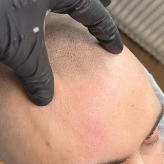 NATURAL ENOUGH?👌🏽💨

Super clean results for this client 🍿

#smp #tattoos #baldness #happy #resul